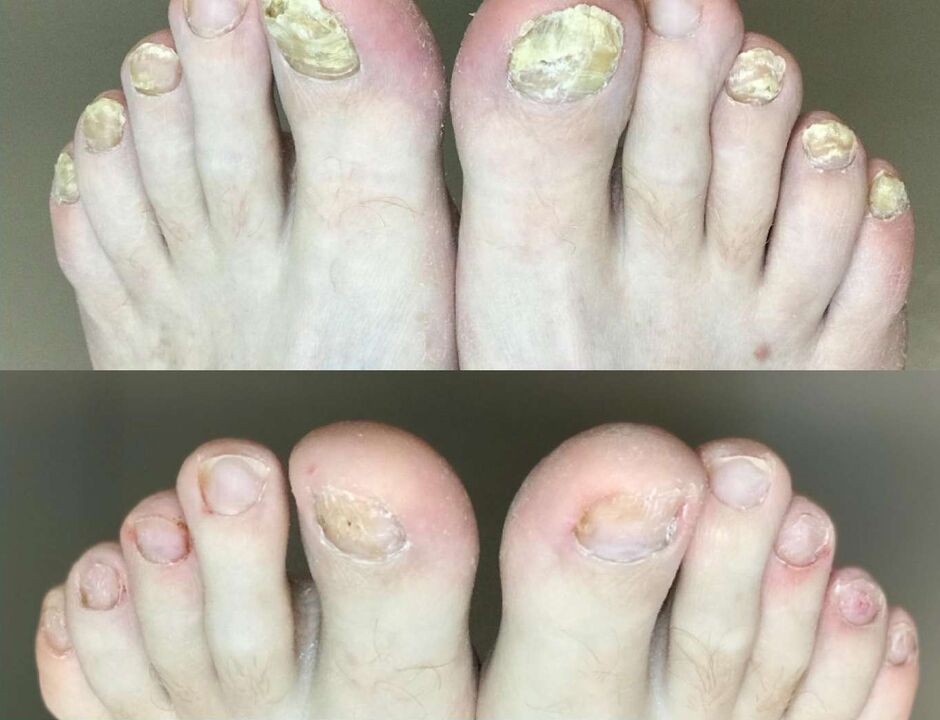 Avant et après le traitement, la crème champignon promisil