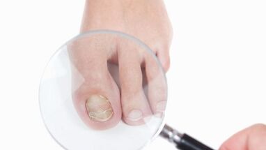 Comment traiter un champignon sur le pouce de la jambe