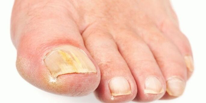 Produits efficaces des champignons à ongles