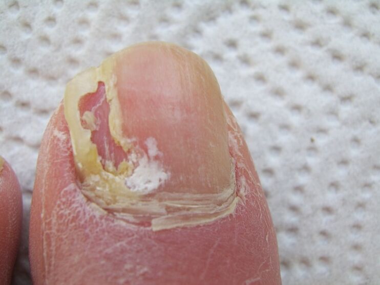 Avec l'onychomycose, une déformation de la plaque à ongles se produit