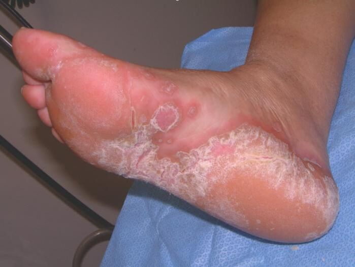 Pied affecté par une infection fongique